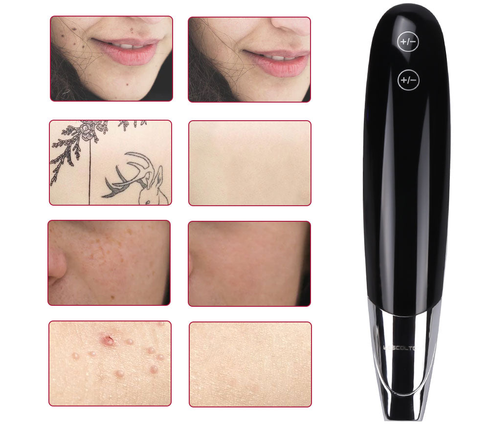 Picosecond Laser Pointer Removal Beauty Treatment